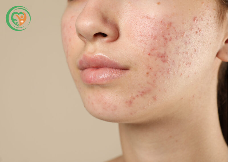 Mụn viêm lan rộng là một trong những tình trạng mụn thường gặp trên da