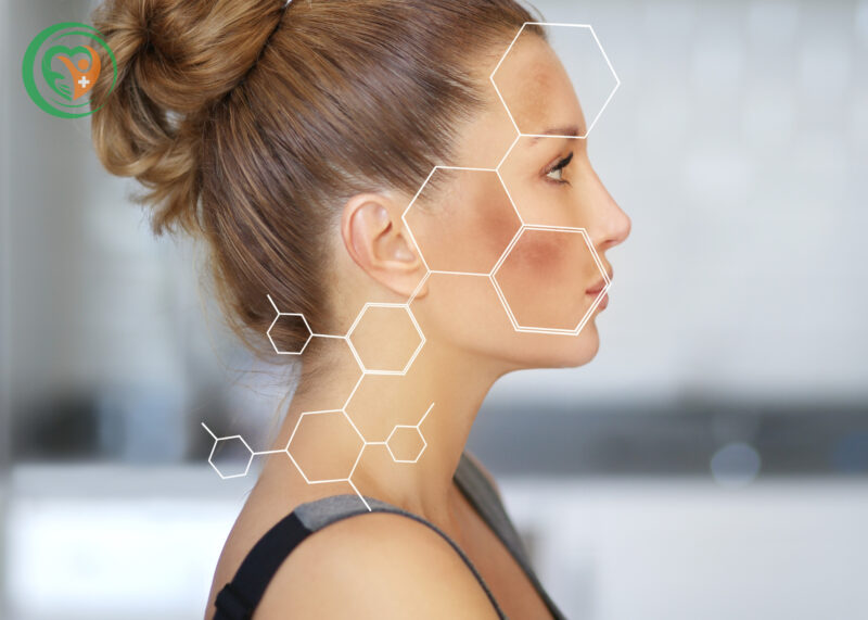 Nám da xuất hiện do nhiều yếu tố bên trong lẫn bên ngoài