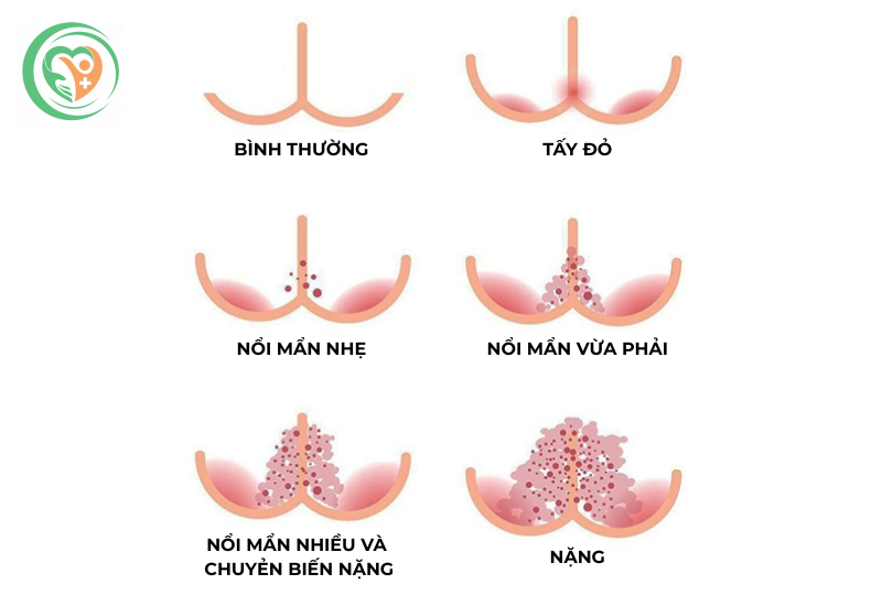 Các mức độ hăm da ở trẻ