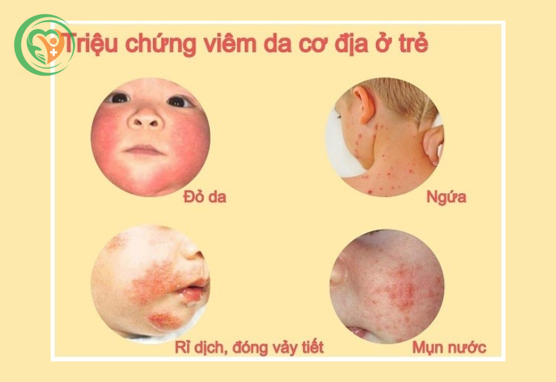 Triệu chứng viêm da cơ địa ở trẻ